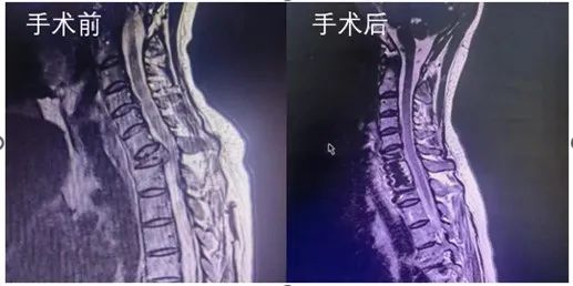 在刀尖上舞蹈的高精尖技术——市中心医院脊柱外科常规开展脊柱肿瘤椎体切除减