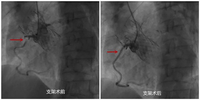 “心突破”解除患者“心头大患”——市中心医院东院心血管内科二病区成功完成